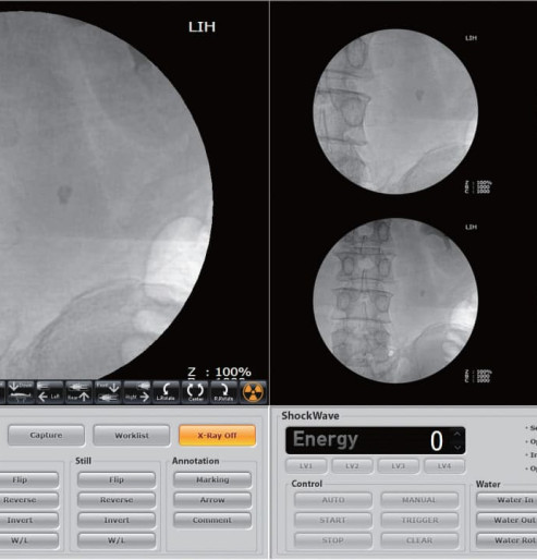 Urological lithotripter ASADAL M1 with C-Arm
